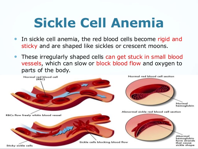 sickle cell anemia hand foot syndrome